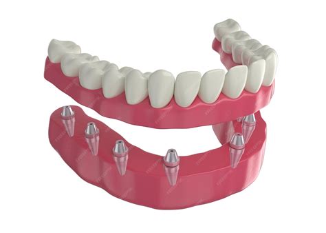 Premium Photo | Dental prosthesis, 8 overdenture implants, lower arch ...