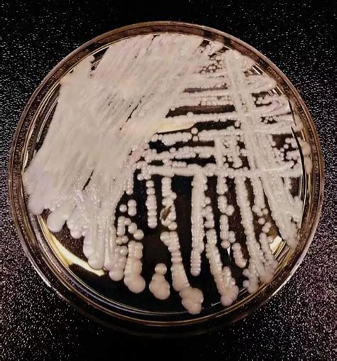 中国确诊18例超级真菌感染 超级真菌感染被美列为紧急威胁_国际新闻_海峡网