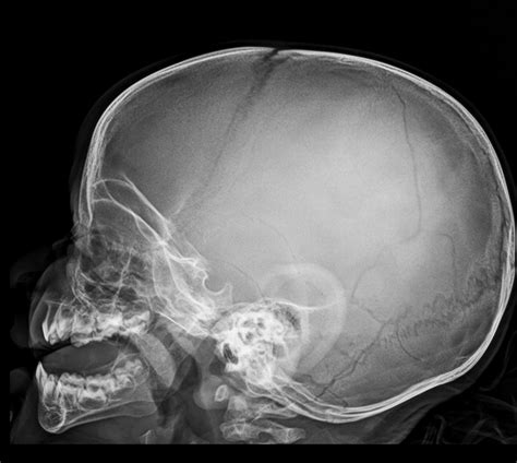 Seeing A Bullet In Head X Ray: Finding Details In The Scan
