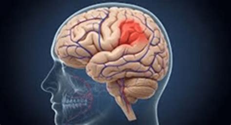 Brain hemorrhage: Why does it happen? Learn from experts its causes ...
