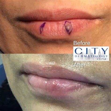 Before and After Photos Mole Removals
