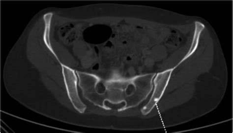 Sclerotic Bone Lesions