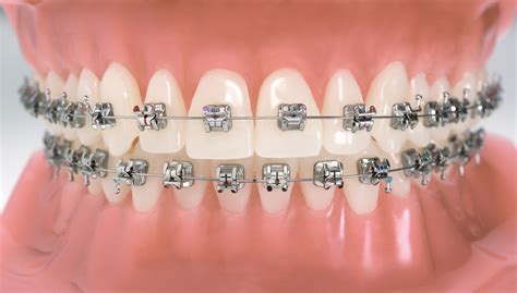 Brackets
