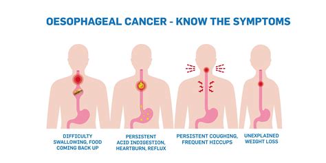 What Are The Warning Signs For Esophageal Cancer at Kermit Bourdon blog