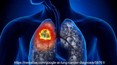 IASLC World Conference on Lung Cancer--Press Briefing Summary from ...