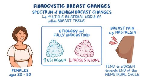 Fibrocystic breast changes: Clinical sciences - Osmosis Video Library