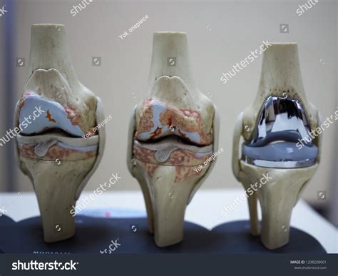 2,648 Knee Joint Replacement Surgery Images, Stock Photos & Vectors | Shutterstock