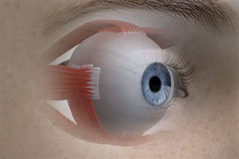 Strabismus: Causes, Symptoms and Treatment | Focus Eye Clinic