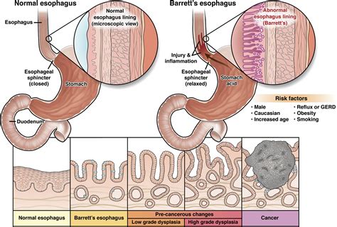 Barretts Esophagus Printable
