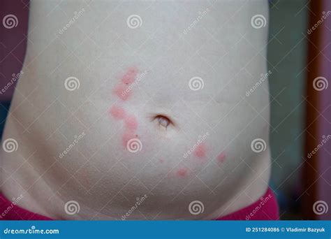 Pimples In The Stomach