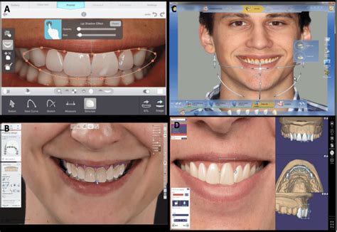 AI in smile design