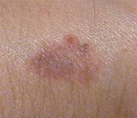 Enfermedad de Bowen (CIE-11: 2E64 / CIE-10: D04) 🚨 - Online AI ...