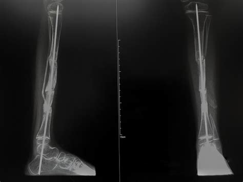 Osteogenesis Imperfecta - Gejala, Penyebab, dan Pengobatan - Alodokter