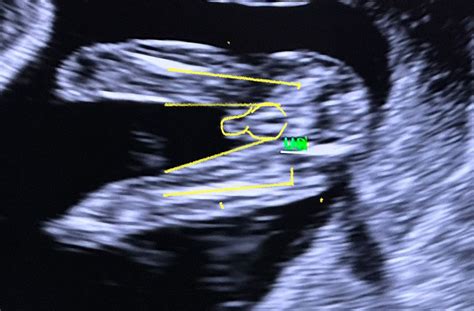 Boy or girl ???any us tech ?? Nub theory ..help! | BabyCenter