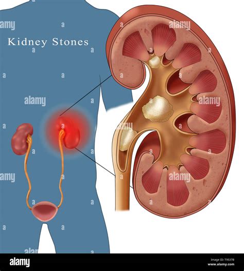 Aspirin For Kidney Stone Pain at Harrison Fitch blog
