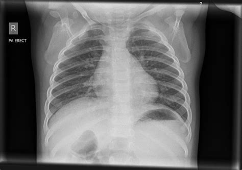 Normal Chest X Ray Child