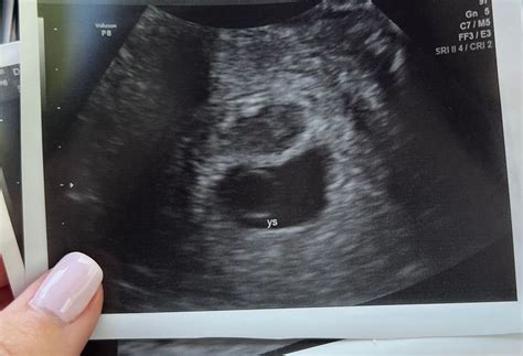 6 weeks 1 day ultrasound twins? | BabyCenter