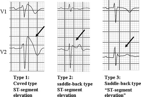 Brugada Syndrome Ecg Patterns – Brugada Sign Ecg – ATCYE