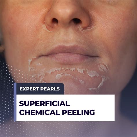 Superficial Chemical Peels | Expert Pearls - Next Steps in Dermatology
