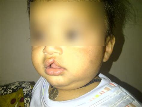 Aesthetic and Cosmetic Surgery - Indoor Admission Basis