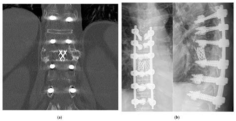 Outcome after Posterior Vertebral Column Resection in Patients with ...