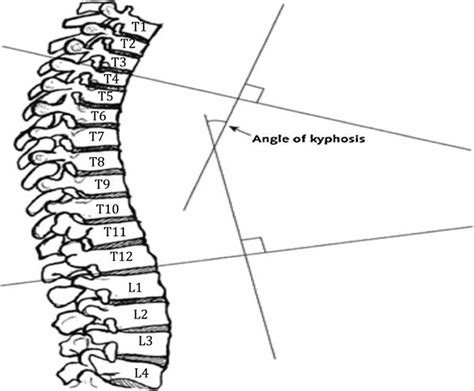 Scheuermann's disease causes, symptoms, diagnosis, treatment & prognosis