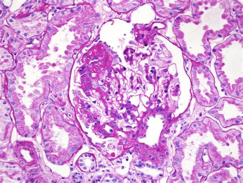 Foam Cells Glomerulosclerosis at Darlene Watson blog