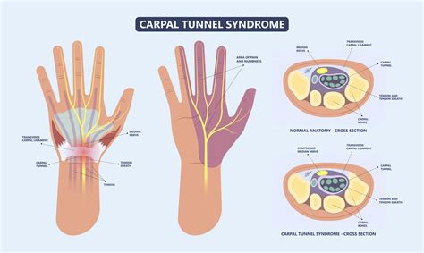 All Carpal Tunnel Syndrome | Advanced Ortho and Spine
