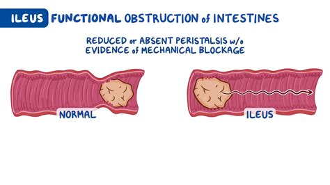 Understanding ileus: causes, symptoms, and treatment options | ileus diagnosis guidelines – Akapv