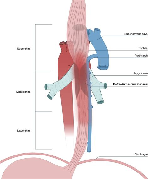 Robot-assisted oesophagectomy (Ivor-Lewis) for a complex stenosis previously managed by open ...