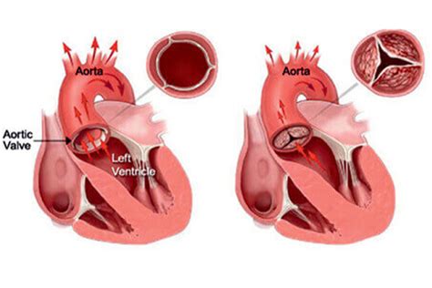 Catheter Based Valve Implantations (TAVI/TAVR) in Mumbai