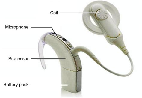 Cochlear Implant, Brainstem Implant and BAHA Chapter Notes - Ear Nose ...