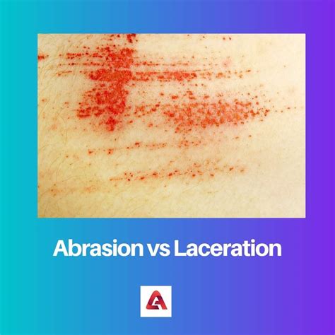 What Is The Difference Between Abrasion And Corrosion at Lucinda ...