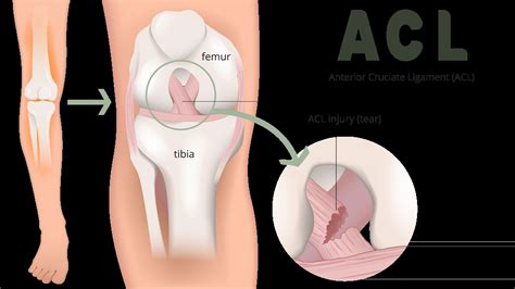 Can You Tear Your ACL Without Knowing? - Dr. Eric Giang