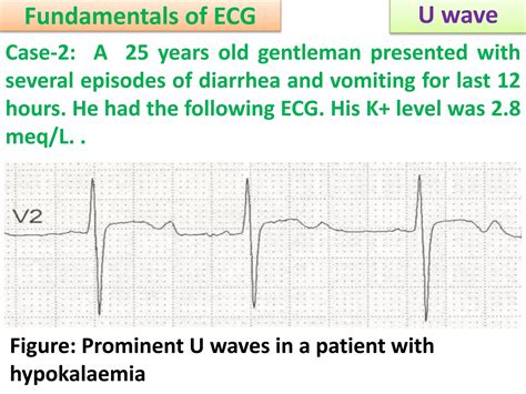 Approach to a patient with U wave in ECG | PPSX - u wave ekg