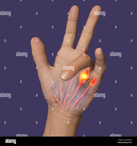 Dupuytren's Contracture Treatment Orthobullets at Louise Rizo blog