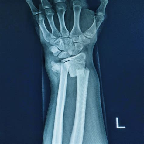 Decoding Wrist Injuries: Understanding Sprains vs. Fractures | by ...