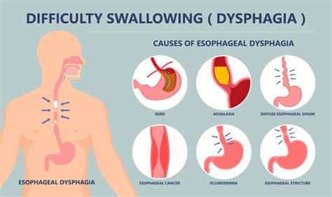 Causes and Solutions for Dysphagia - Suzy Cohen, RPh offers natural ...