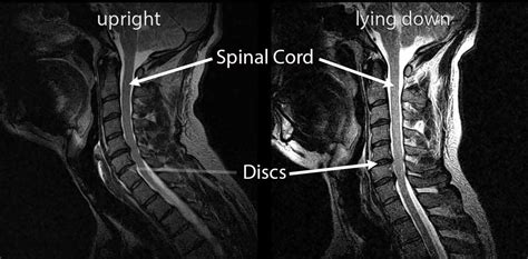 Spinal Cord Compression 的图像结果