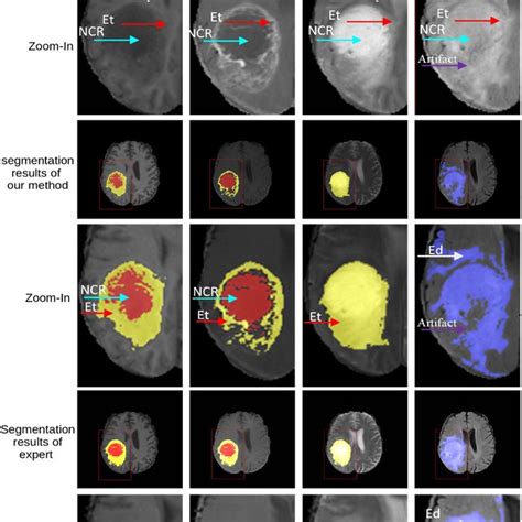 Image result for Tumor Segmentation Using Python