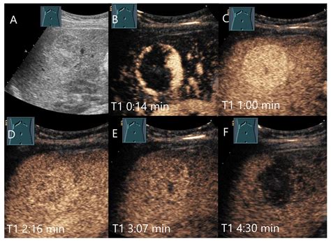 Washout on Contrast-Enhanced Ultrasound of Benign Focal Liver Lesions—A Review on Its Frequency ...