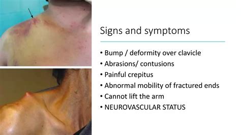 clavicle fracture.pptx