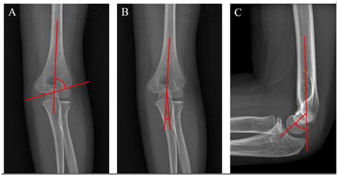 Associated Factor and Long-Term Clinical Outcomes for Patients with ...