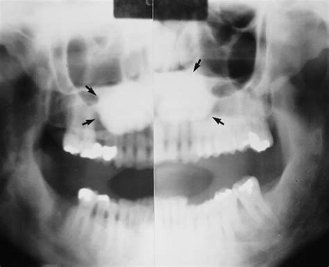 Imaging Torus Lesions of Jaw Bones | Applied Radiology