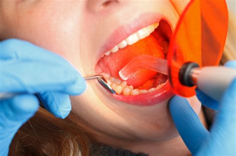 The 4 Basic Types of Dental Fillings | Voyles Family Dental