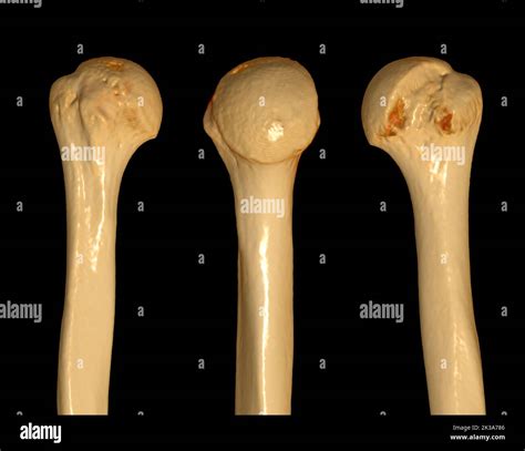 CT scan of head of humerus 3D of Computed Tomography Volume Rendering ...