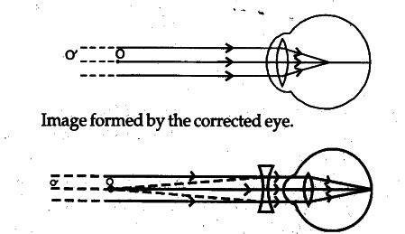 List two causes leading to myopia of the eye - CBSE Class 10 Science ...