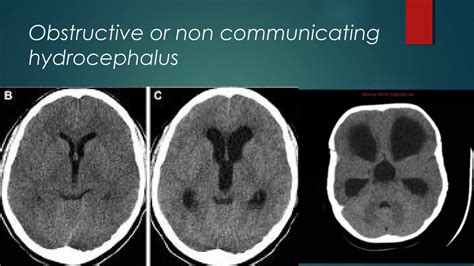 Hydrocephalus | PPT