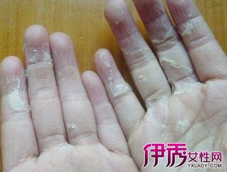 【手掉皮是怎么回事 怎样能治好】【图】5个原因告诉你手掉皮是怎么回事 怎样能治好好对症下药(3)_伊秀健康|yxlady.com