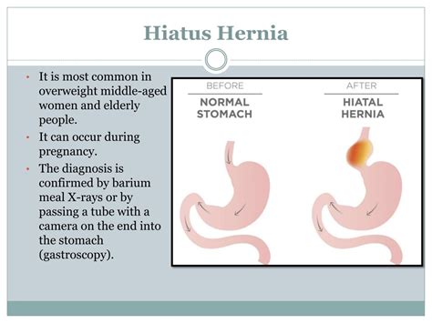 Does A Hiatal Hernia Cause Weight Gain | Detroit Chinatown